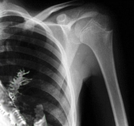 An X-ray that apparently shows a fir tree growing inside a 28-year-old man