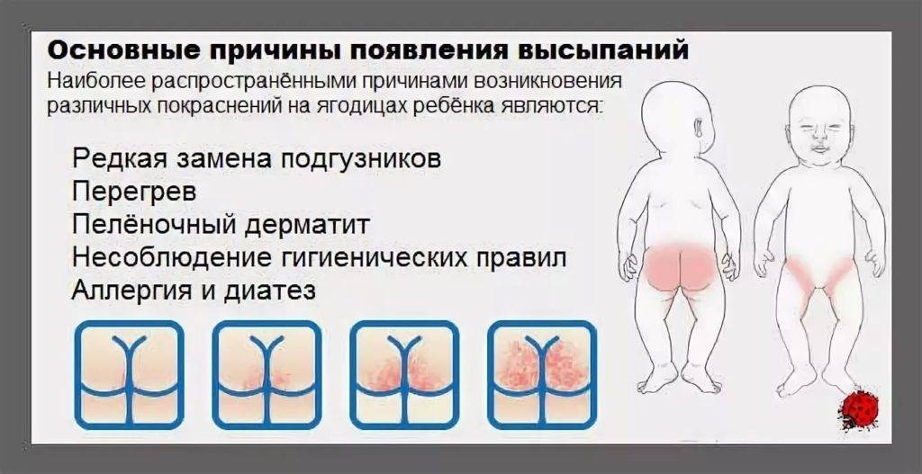 Аллергия на попе у ребенка: причины, симптомы и лечение