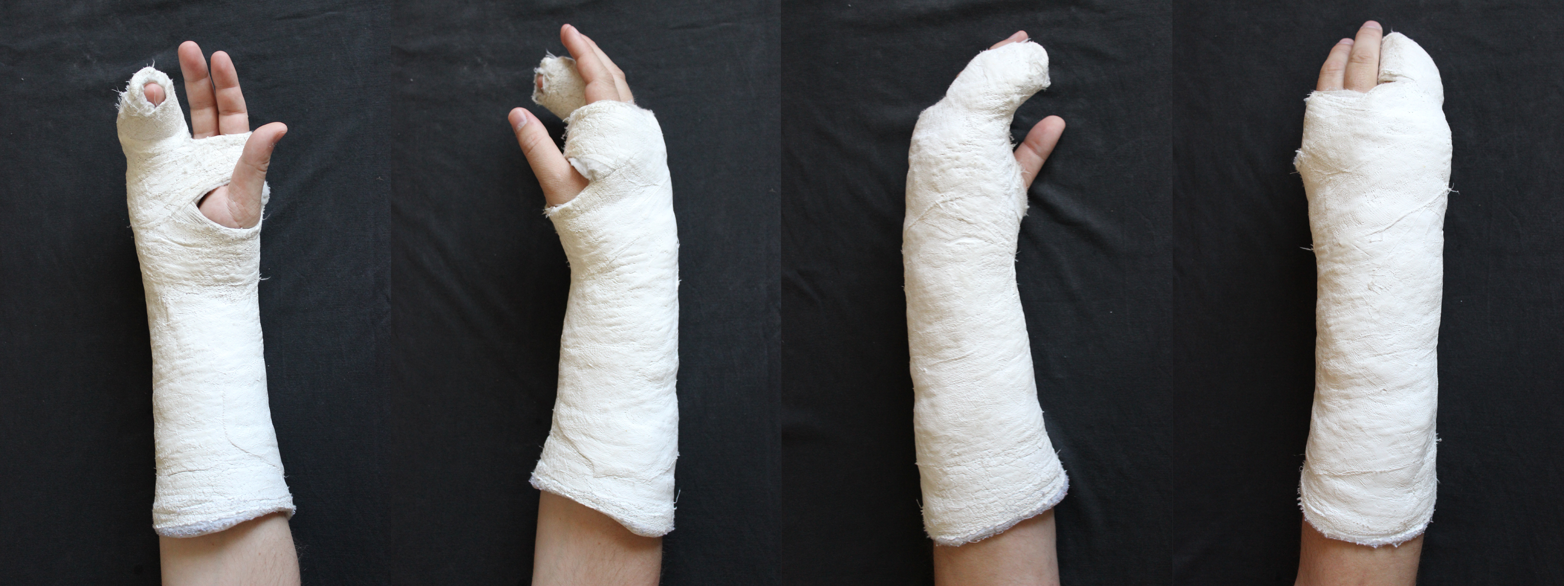 Фото гипс на руке: Gipsverband Изображения, стоковые фотографии и картинки Gipsverband