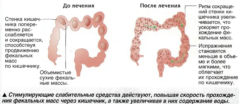 Мыло при запоре у новорожденного: эффективность и безопасность применения